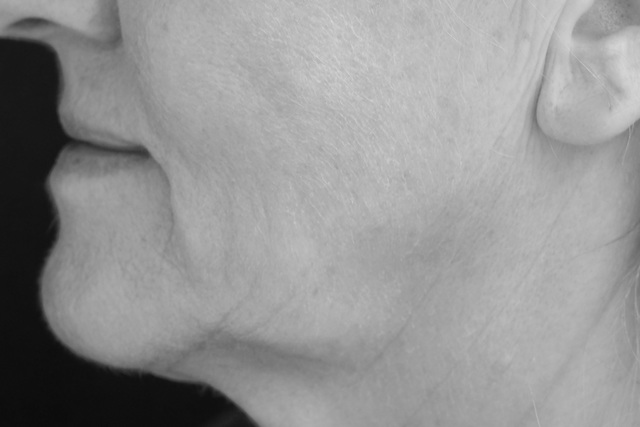 Untergesicht Jaw-Line